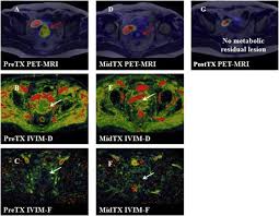 If there are signs and symptoms of cervical cancer, or if the pap test reveals abnormal cells, a doctor may recommend additional tests. Early Treatment Response Of Patients Undergoing Concurrent Chemoradiotherapy For Cervical Cancer An Evaluation Of Integrated Multi Parameter Pet Ivim Mr European Journal Of Radiology