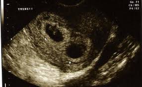 We did not find results for: Twins At 6 Weeks What S Like In Ultrasound Pictures New Kids Center