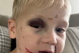 Un petit garçon d'un an revient avec des bleus et des égratignures de son  premier jour à la crèche : "C'est le cauchemar de tous les parents"