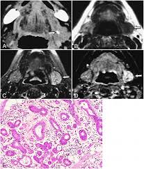 Image result for Sialoadenitis
