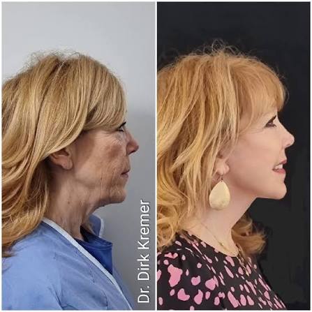 A 62-year-old face that still felt so much younger the inside. This is the  kind of transformation that reminds me why the deep plane facelift and deep  neck lift remain the gold