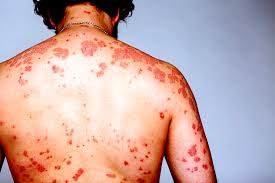 Image result for skin rash acute hiv infection