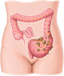 È ovvio che diventa quali impossibile evitare totalmente questi alimenti ma, nel periodo della comparse dei primi sintomi di diverticolosi è consigliabile non consumarli. Diverticolite Ecco La Dieta E Le Possibili Cure