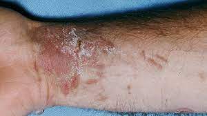 For the treatment of allergic dermatitis, patients in the first stages need the appointment of desensitizing agents (antihistamines, calcium preparations) in combination with external methods of treatment (5% dermatol emulsion, lanolin emulsion zinc ointment, 3% naphthalene paste. Phytophotodermatitis Symptoms Causes And More
