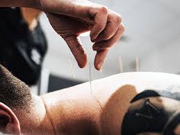 Image result for Acupuncture