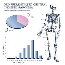 Image result for Chondrosarcoma