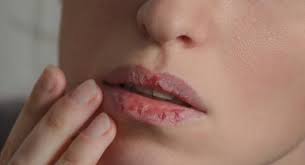 Cara ini cukup dengan merendam tangan anda ke dalam air cucian beras tersebut, lalu gosok dan diamkan lagi hingga 10 menit. 5 Cara Mengatasi Bibir Pecah Pecah Hingga Berdarah