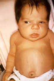 Neonatal jaundice is extremely common. Neonatal Jaundice Wikipedia