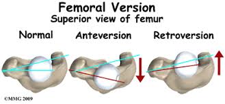 Image result for Femoral Retroversion
