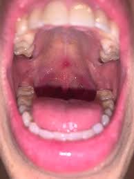 Image result for Canker sores symptoms roof of the mouth