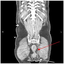 Image result for Ischiorectal Abscess