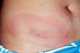 Lb je způsobena bakterií komplexu borrelia burgdorferi sensu lato. Slovenija Najbolj Ogrozena Na Svetu Letosnje Stevilke Se Bolj Zaskrbljujoce Zurnal24