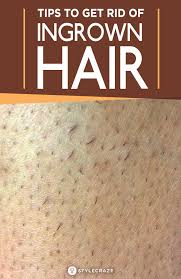 Sometimes you can see a hair trapped under the skin. 15 Simple Tips To Reduce The Growth Of Ingrown Hair Weird Bumps Have Sprung Up On Your Face And Body In 2021 Ingrown Hair Unwanted Hair Removal Ingrown Hair Remedies