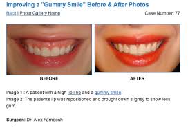 Gummy Smile Correction Surgery Gummy Smile Gummy Smile Surgery Gummy Smile Correction