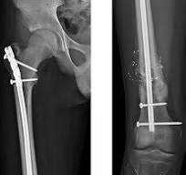 Adolescent Lateral Entry Femoral Nail