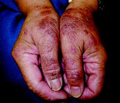 Image result for Rhus Dermatitis