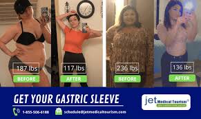 After dropping 110 pounds, she needed a. Gastric Sleeve Results Expected Weight Loss After Vsg Surgery