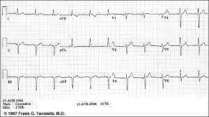 What does abnormal ecg mean? Ecg Learning Center An Introduction To Clinical Electrocardiography