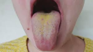 Image result for yellow tongue infection