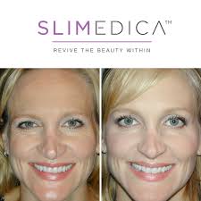 Pin On Botox Dysport