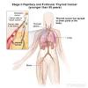 Occasionally, it is secondary in nature, with the primary site elsewhere in the body. 1