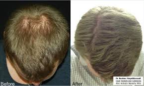 Vitruvian Method Encompasses Vitruvian Design Natural Hairlines Maximum Density Strategic Placement Temple Angle Clos Hair Transplant Hair Long Hair Styles