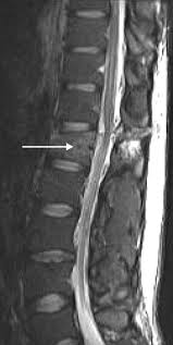 Image result for Chance Fracture