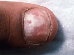 Image result for onychomycosis