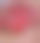 Image result for Pyoderma Gangrenosum