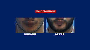 A facial hair transplant is a treatment that gently harvests healthy follicles, delineates them by texture and viability, then transports them to the face for natural growth. Beard Transplant Safe And Proven Result Hair Transplant Philippines
