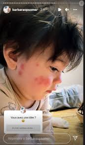 Photo : Gabriel, le bébé de Barbara Opsomer, le visage recouvert de tâches  rouges