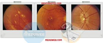 presumed ocular histoplasmosis syndrome pohs meduweb