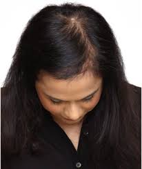Unique hair and beauty heywood. Hair Systems Manchester Hair Loss Clinic Non Surgical Hair Replacement