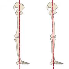 Fixing Hyperextended Knee Posture Somastruct Hyperextended Knee Posture Fix Postures