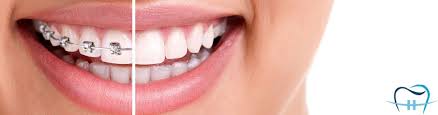 We have all the information you need about public and private dental clinics that provide braces in ireland. Woodlands Orthodontics Bray And Greystones Specialist Orthodontist