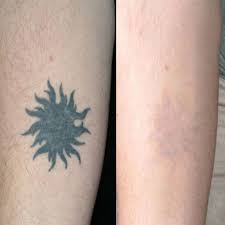 Tattoo After 6 Weeks Lemon This Ingredient Can Take It Off Learn More About Laserless Tattoo Removal Here Http La Tattoos For Women Tattoos Laser Tattoo