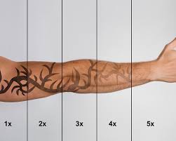 We list 7 common laser tattoo removal side effects. The Reasons Why Tattoo Removal Is Big Business