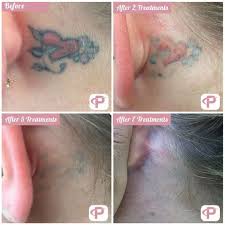 Some desperate bearers have tried slicing into the tattoo and rubbing salt into it to wear the skin away. Laser Tattoo Removal Before And After Photos Premium Tattoo Removal