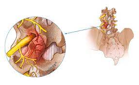 Das facettensyndrom gehört zu den degenerativen (verschleißbedingten) erkrankungen der wirbelsäule. Facettensyndrom Symptome Behandlung Op Joimax