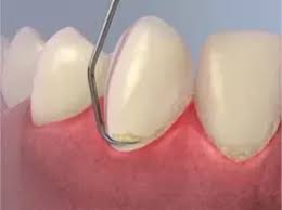 This is natural methods to get rid of plaque at home.you can try this home remedis to tre. Scraping Plaque Off Teeth With Fingernail Teethwalls