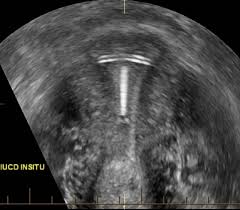 Performance of an ultrasound examination of the female pelvis introduction t he american institute of ultrasound in medicine (aium) is a multidisciplinary association dedicated to advancing the safe and effective use of ultrasound in medicine through professional and public education, research, development Normal Uterus Ultrasound How To