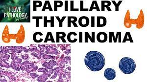 They tend to grow very slowly. while follicular thyroid cancers. Papillary Thyroid Carcinoma Gross And Microscopic Features Youtube