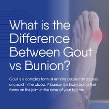 Image result for gout symptoms toe