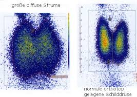 Die schilddrüsenszintigraphie ist eine untersuchung, um die struktur der schilddrüse zu untersuchen und ihre funktionsweise zu beobachten. Diagnostik Bei Verdacht Auf Eine Erkrankung Der Schilddruse