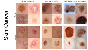 Most cases of basal cell carcinoma and. Dr Rami Abadi General Dermatology Cosmetic Dermatology And Laser Specialist Beirut Lebanon