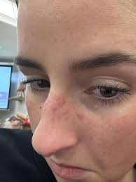 My sister has had HSV breakouts