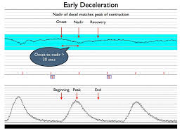 basic pattern recognition electronic fetal monitoring