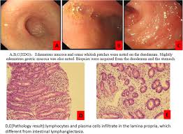 Image result for Intestinal Enteropathy