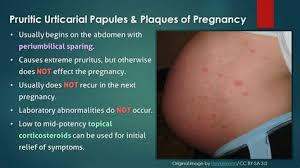 Image result for pruritic urticarial papules and plaques of pregnancy