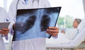 Mehr zu symptomen, diagnose, behandlung, komplikationen, ursachen und prognose lesen. Legionellen Legionarskrankheit Netdoktor Ch